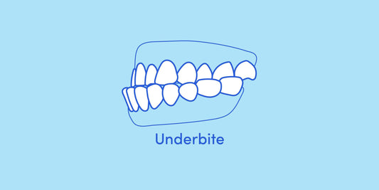 What is a "Receptive Mouth" (mandibular prognathism)? How to fix it with mouthpiece orthodontics and cost